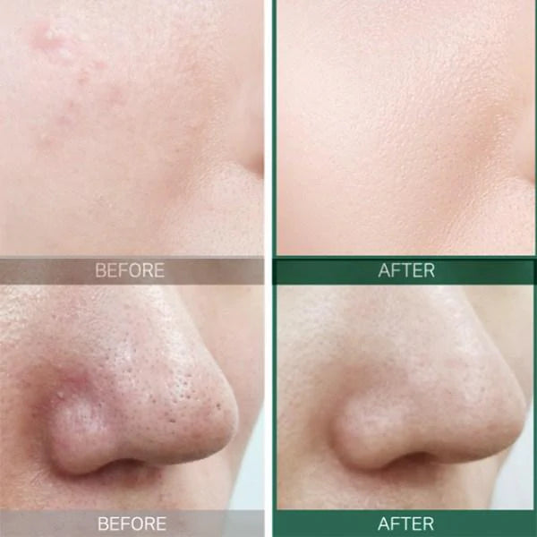 AHA BHA PHA 30 Days Miracle STARTER KIT Edition